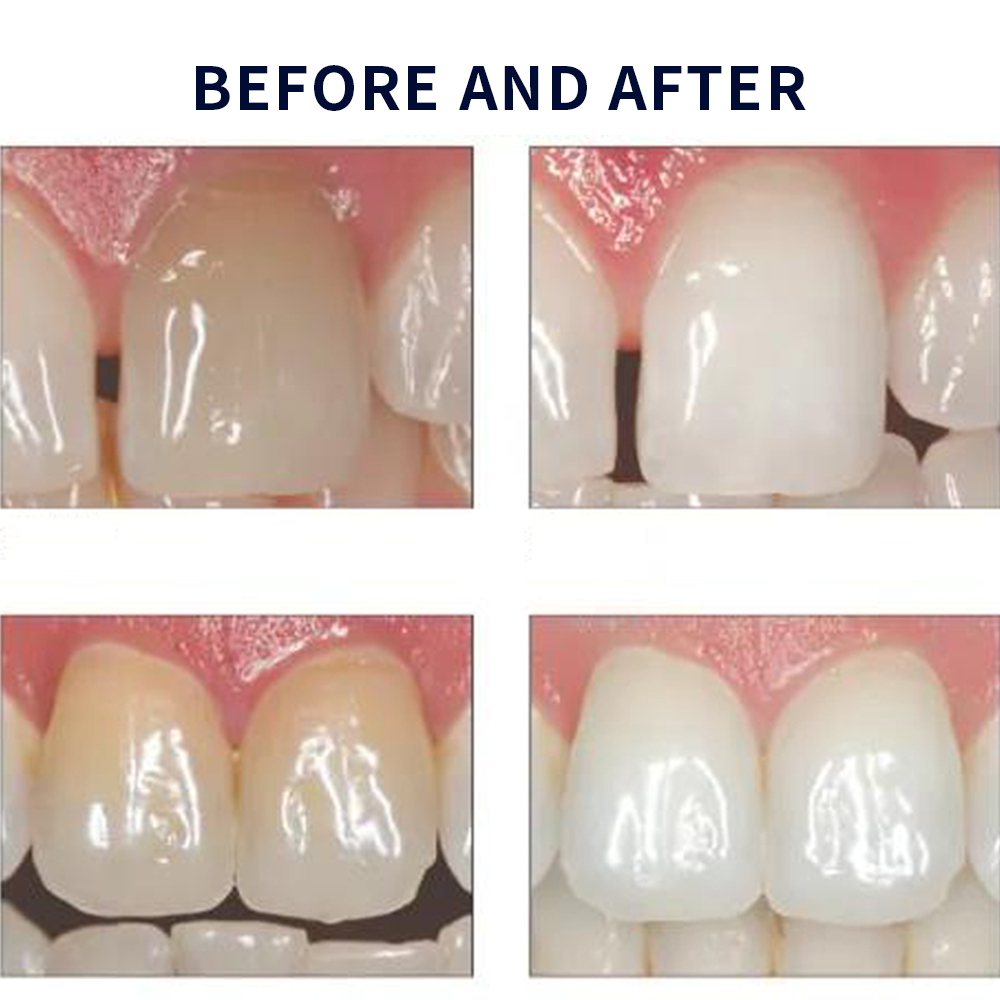 Opalescence Whitening 20% PF 2 - Teeth Whitening Bleaching Kit 评论和价格