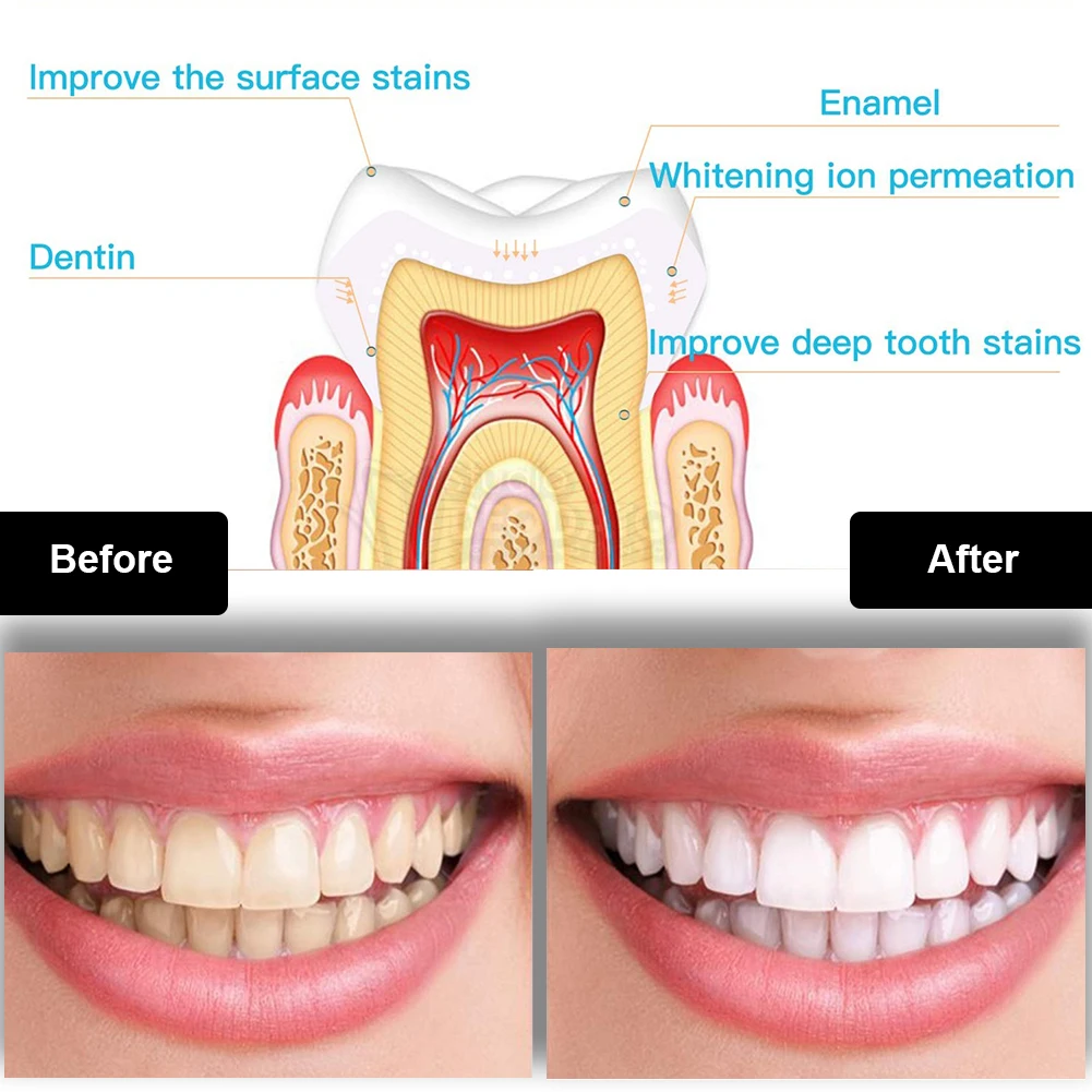 Dental Teeth Whitening Kit Min - Teeth Whitening Bleaching Kit 评论和价格